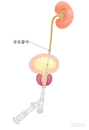 요관경하 배석술