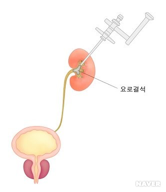 경피적 신쇄석술