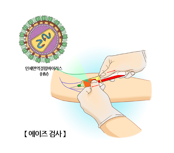 에이즈 치료