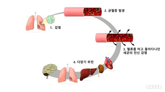 패혈증 정의