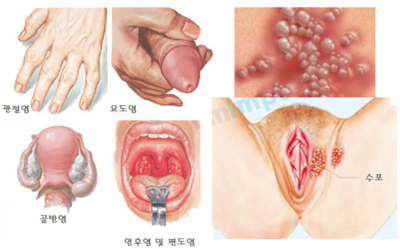 남자 여자 임질 증상