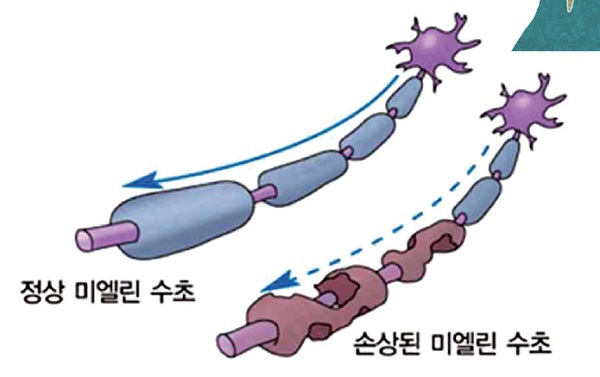 다발성 경화증